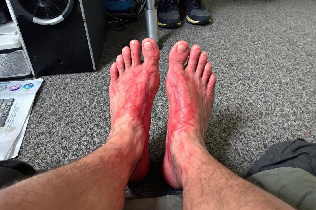 Deux pieds rouges et irrités posés sur un tapis gris